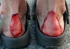 blistered bleeding feet