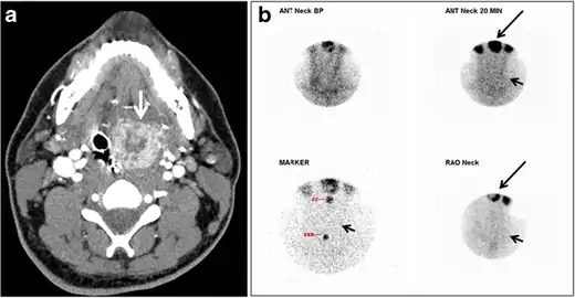 Fig. 18. Lingular thyroid in a 33-year-old male who presented with oropharyngeal bleeding. an Axial enhanced neck CT scan at the level of mandible demonstrates a 3 × 3 × 3.4&nbsp;cm round, partly well-delineated, heterogeneously enhancing lesion (white arrow). It is predominantly on the left side of the oropharynx and to some extent at the mid part of the base of the tongue. The thyroid gland was normal (not shown). b Image of the anterior face and neck taken 20 minutes after Tc99m-Pertechnetate injection shows absent thyroid radiotracer uptake in normal thyroid anatomical location (black short arrows). There is an area of increased uptake (long black arrows) corresponding to the posterior tongue mass identified on CT scan.