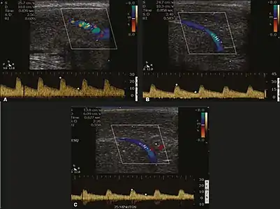 Longitudinal, ventral ultrasound of the penis, with pulsed mode and color Doppler. Flow of the cavernous arteries at 5, 15, and 25 min after prostaglandin injection (A, B, and C, respectively). The cavernous artery flow remains below the expected levels (at least 25–35&nbsp;cm/s), which indicates ED due to arterial insufficiency.