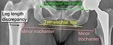 Leg length discrepancy after hip replacement is calculated as the vertical distance between the middle of the minor trochanters, using the acetabular tear drops or the transischial line as references for the horizontal plane. A discrepancy of up to 1&nbsp;cm is generally tolerated.