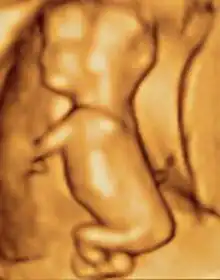 3D ultrasound of 80-millimetre (3&nbsp;in) fetus (about 3+1⁄2 months gestational age)